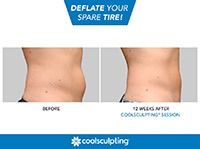 coolsculpt1.jpg